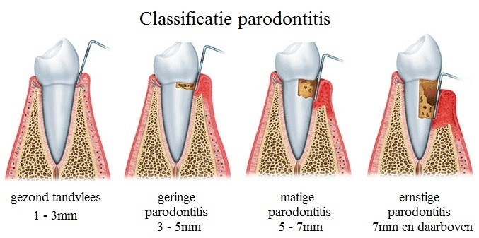 5de foto classificatie parodontitis