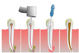 25ste foto wortelkanaalbehandeling tand stappen