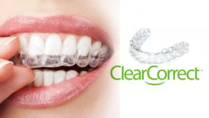 Close-up van een persoon die ClearCorrect-aligners over zijn tanden plaatst, met het ClearCorrect-logo en een afbeelding van de aligner tray.